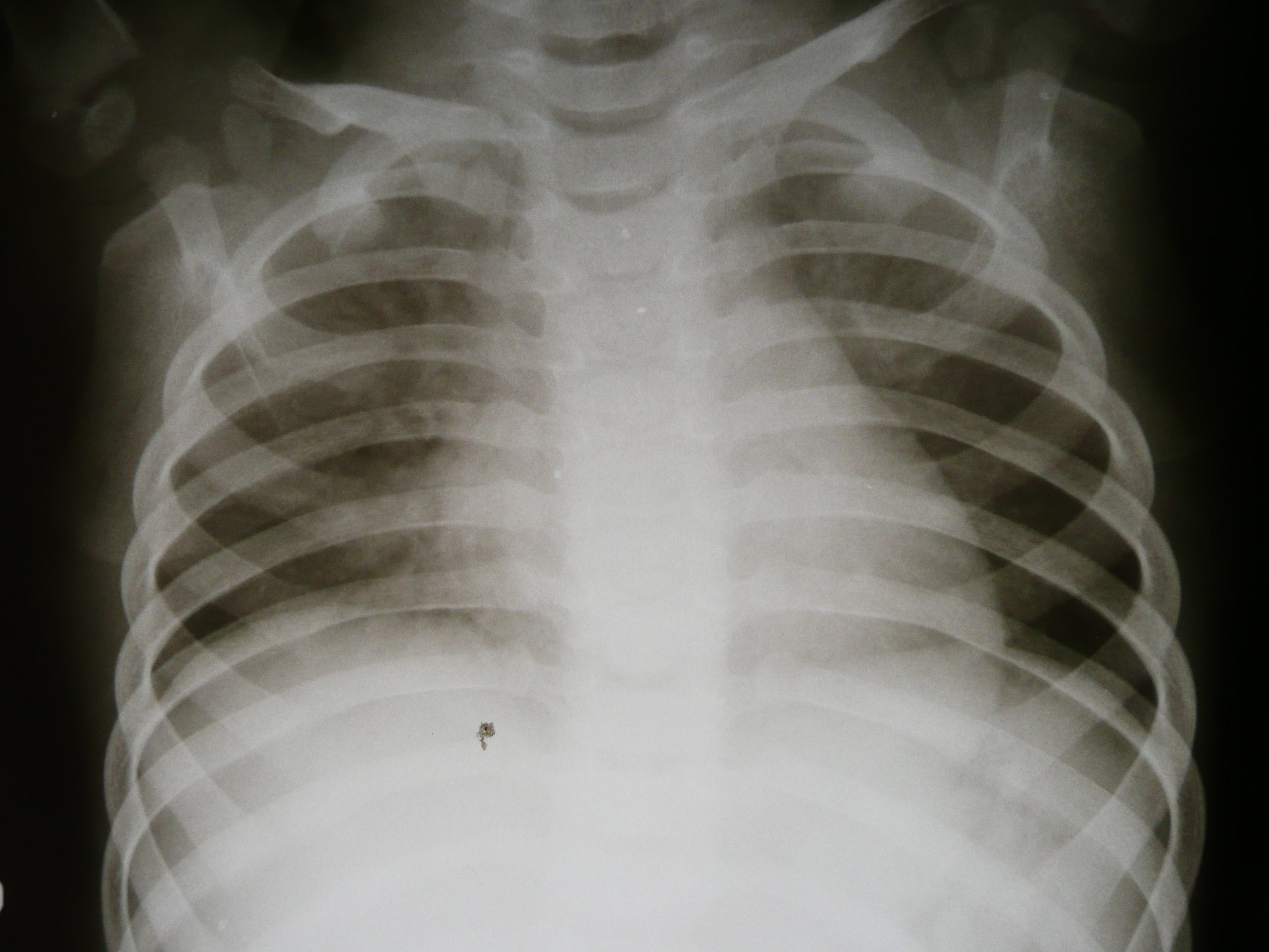 Chest_X-ray_1300276
